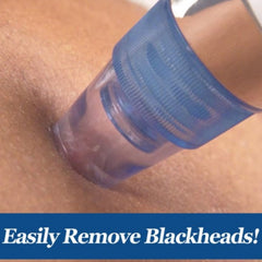 Aparat za uklanjanje mitesera - efikasno i sigurno čišćenje vaše kože