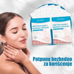 Efikasni flasteri za brzo i sigurno uklanjanje bradavica