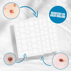 Efikasni flasteri za brzo i sigurno uklanjanje bradavica