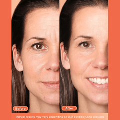 Revolucionarna LED Maska za Savršenu Njegu Kože