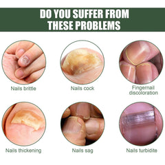 Revolucionarna uljana olovka za borbu protiv gljivica na noktima