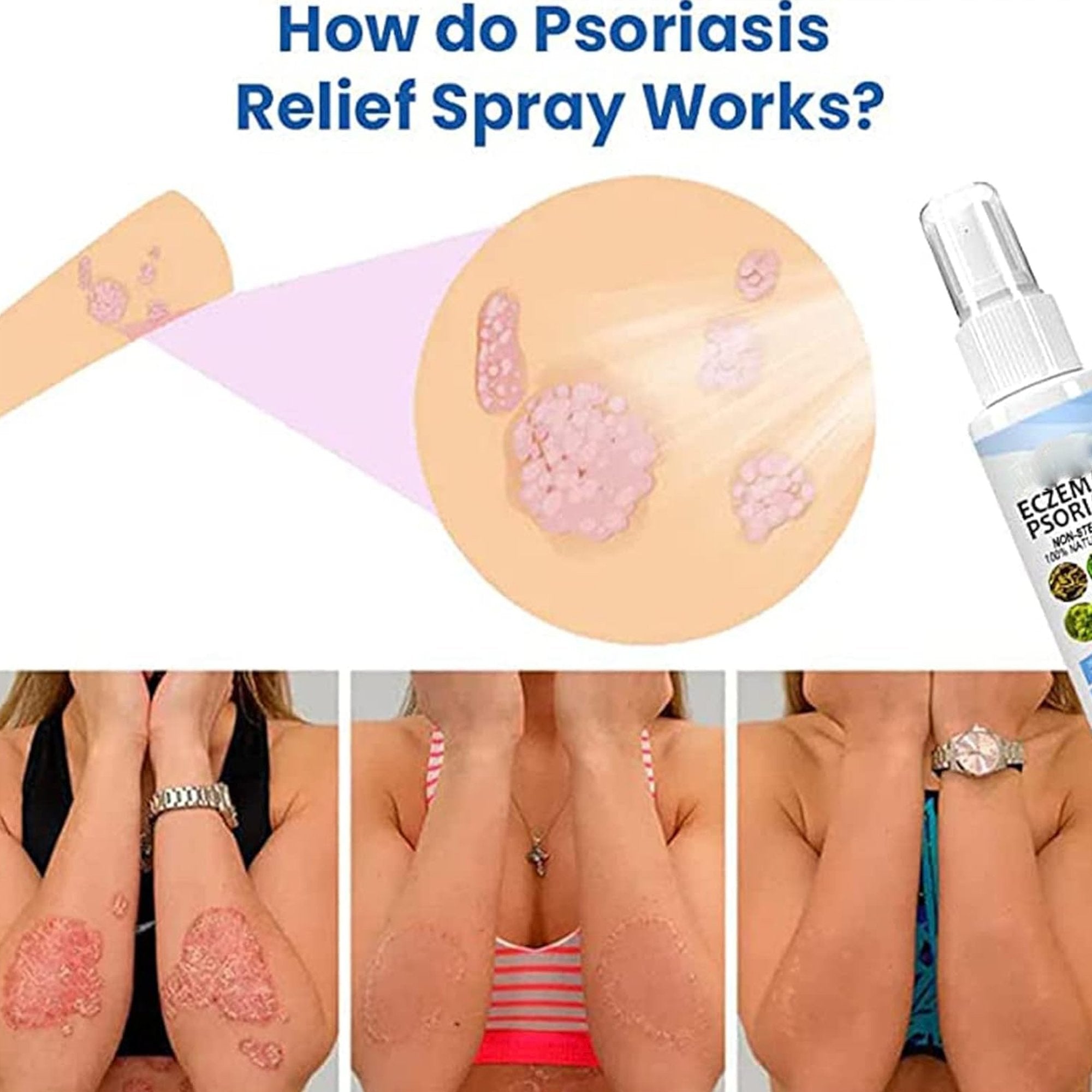 Osvežavajući sprej za ublažavanje psorijaze za brzo i efikasno olakšanje